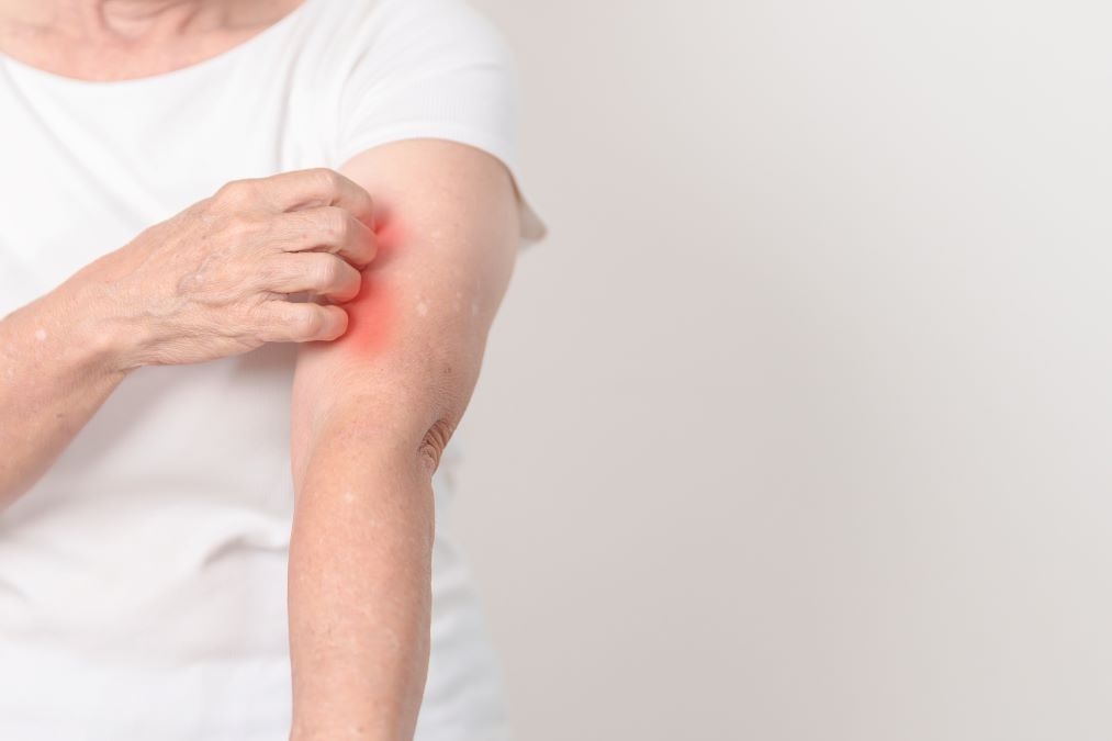 Oltre l’eritema a farfalla: le tante maschere del Lupus Eritematoso Sistemico