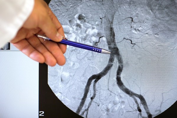 La tecnica Lupiae per trattare l'aneurisma dell'arco aortico: intervista al dottor Esposito