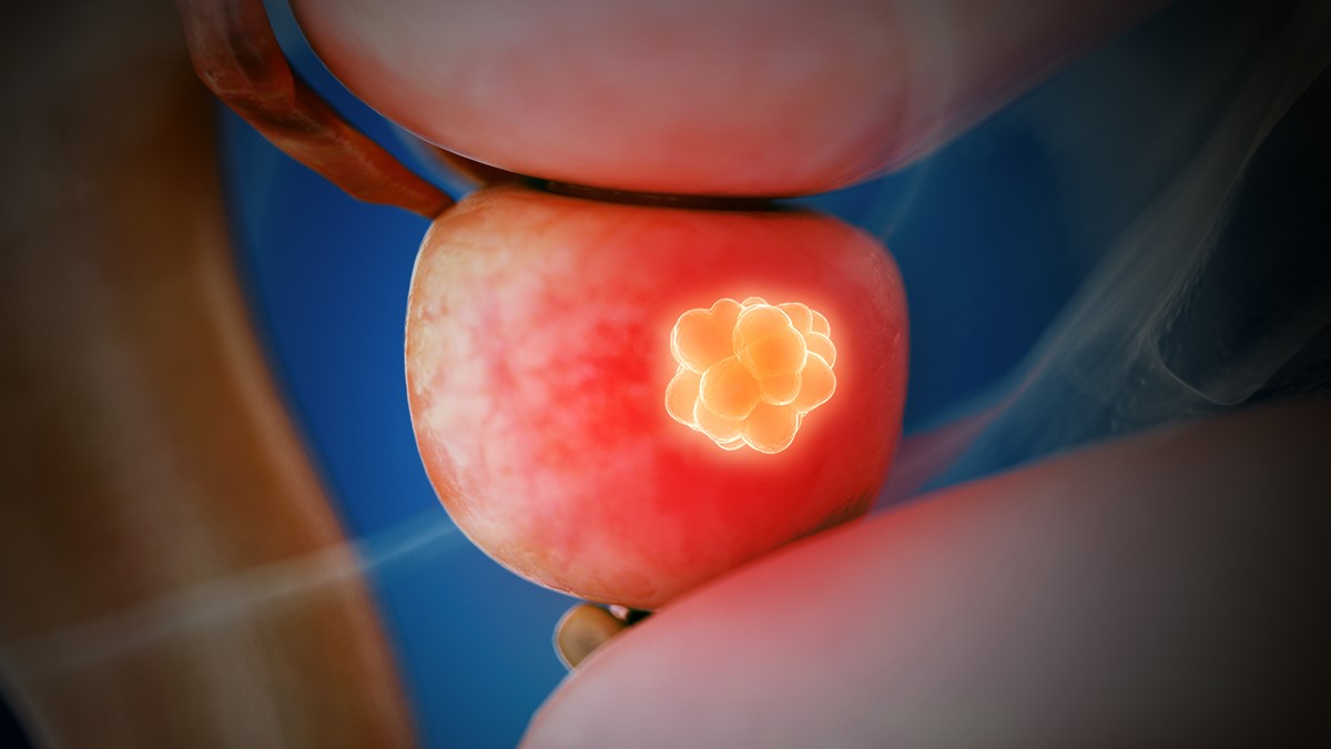 Diagnosticarea cancerului de prostată cu ajutorul fusion biopsy