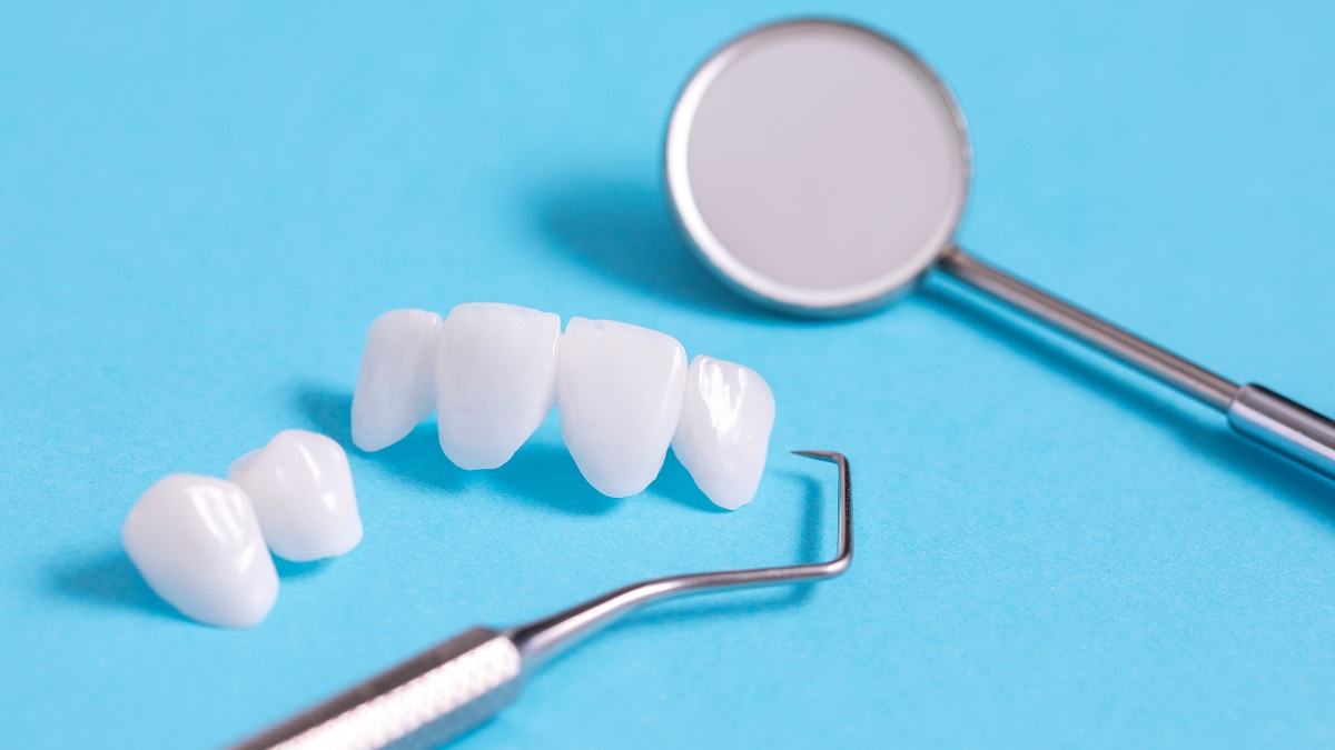  Le faccette dentali: cosa sono e quali modalità di impianto