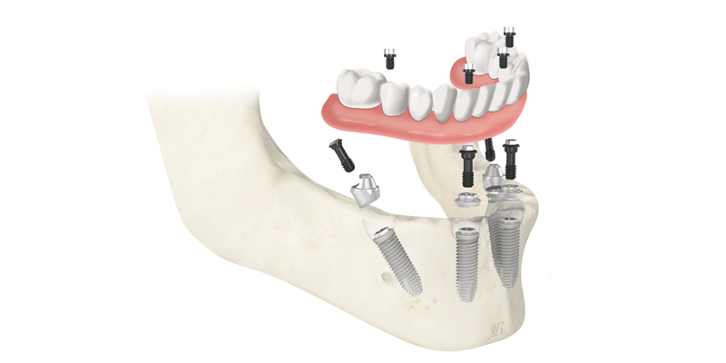 Implantologia dentale a carico immediato: indolore, veloce, sicura