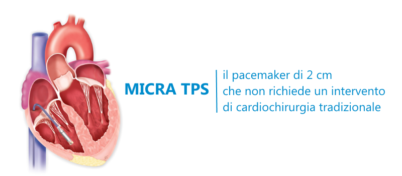 La tecnologia Micra: impiantare un pacemaker senza ricorrere alla chirurgia