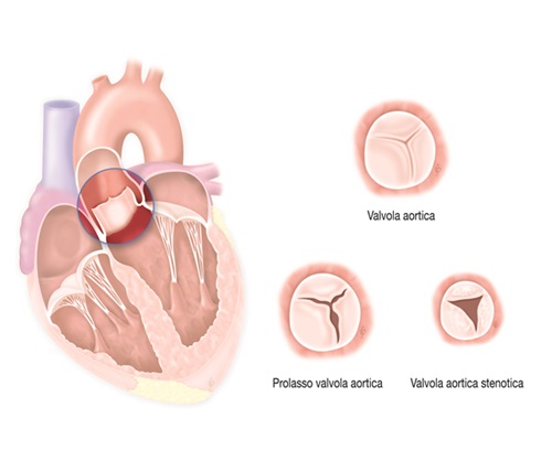 Città di Lecce Hospital: centro di avanguardia per la chirurgia della valvola aortica