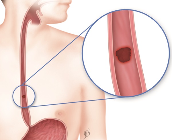 Reflusso gastroesofageo, diverticoli, neoplasie: prevenzione e cura delle patologie dell'esofago