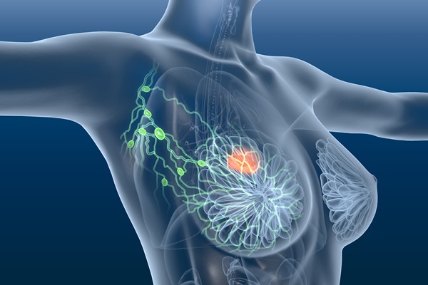 Attualità sui tumori della mammella: specialisti a confronto - GVM