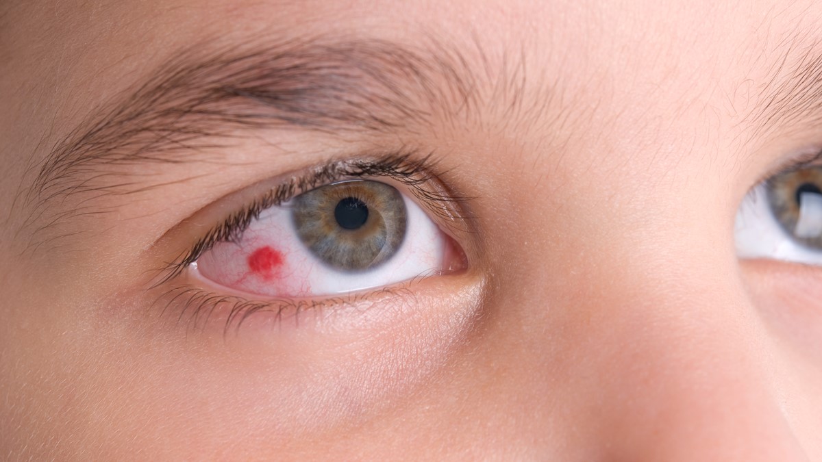 Emorragie oculari: quali sono e come trattarle per riportare l’occhio in salute