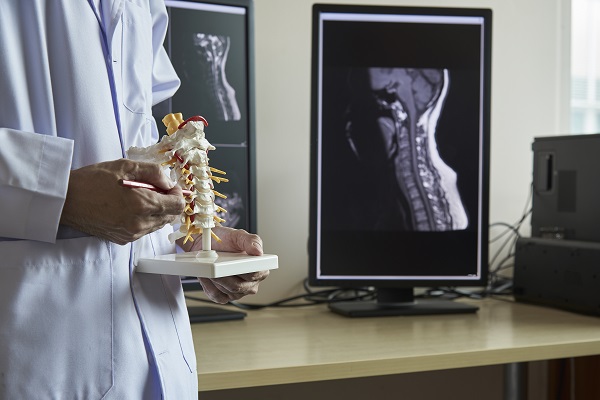 Stenosi spinale e mielopatia cervicale: sintomi, diagnosi e trattamento