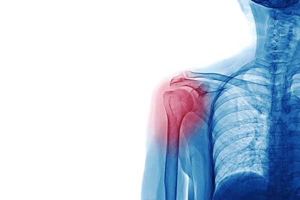La chirurgia della spalla nelle lesioni della cuffia dei rotatori