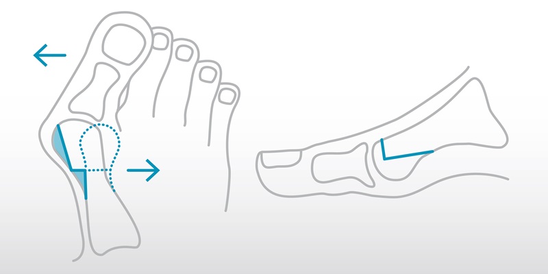 Alluce valgo: una tecnica mini invasiva per trattare la deformità del piede