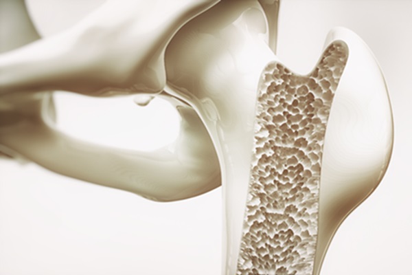 Giornata Mondiale dell'Osteoporosi, i rischi di fratture in età avanzata