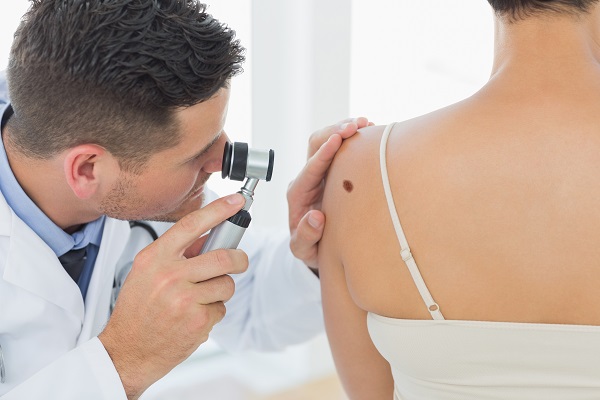 Proteggersi dal melanoma: perché è importante controllare i nei?